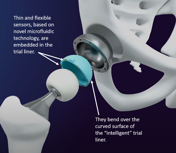 An exploded view of the thin and flexible sensors and the “intelligent” trial liner for the breakthrough technology in hip replacement being developed at Cambridge